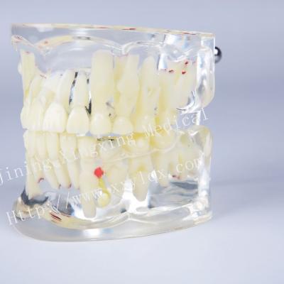 China Vivid pathological dental model with caries calculus implant impaction and missing tooth for treatment demonstration for sale