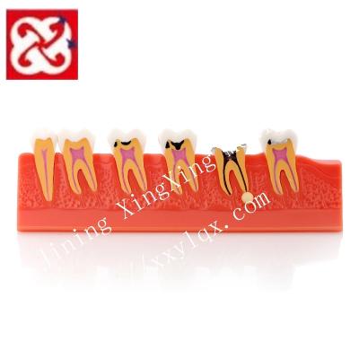 China Detailed anatomy structures caries illustration development dental model cross section showing pulp disease states for sale