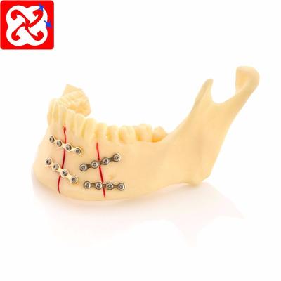 China Detailed anatomy structures restoration jaw model to demonstrate normal fracture part fixed with dental plate model for sale