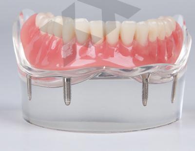 China Detailed Anatomy Structures Mandibular Overdenture Implant Teeth Model With 4 Implants for sale