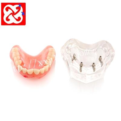 China Detailed Anatomy Structures Maxillary Overdenture Restoration Model With 4 Implant Denture Model for sale