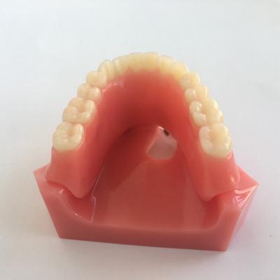 China Detailed Anatomy Structures Overdenture 2 Implants Model With Restoration for sale