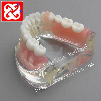 China Detailed anatomy structures partial denture implant and restoration jawbone model for sale