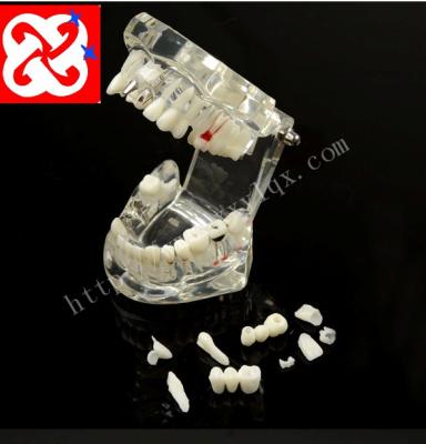 China Multifunctional Medical Training Dental Manikin Implant Model With Restoration And Pathologies for sale