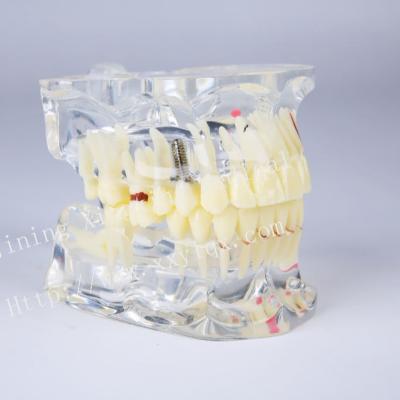 China Adult Tooth Dental Model Study Model Study Pathologies for Dentist - Patient Communication or Student Practice for sale