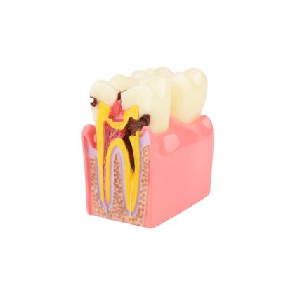 China Resin 6 Times Decay Tooth Model Dental Standard Teeth Teaching Model Teeth Disease Teeth Model for sale