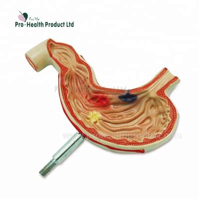 China PVC Medical Science Human Digestive System Stomach Anatomy Pathological Model For Patients Education for sale