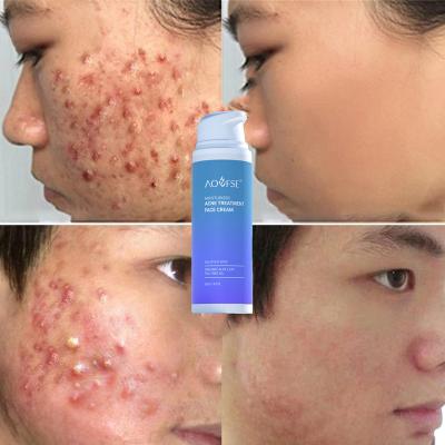 China Organic Herbal Skin Revitalizer 50% Skin Revitalizer Dark Spot Repair Scar Remover Pimple Treatment Acne Cream for sale