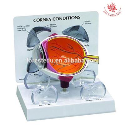 China Doctor Model Cataract Eye Model Pharma Gift And Supply Medical Science Educational Human Disease Anatomy Cataract Eyeball Model for sale