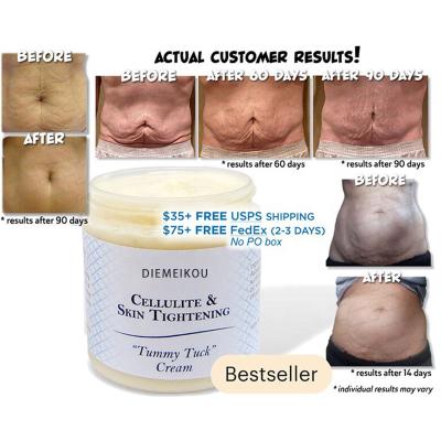 China Anti Scar Private Label OEM Skin Revitalizer Anti Pregnancy Removal Natural Body Repair Stretch Mark Cream for sale