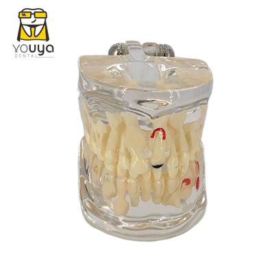 China Durable Pediatric Caries Pathology Tooth Model Dental Model for sale