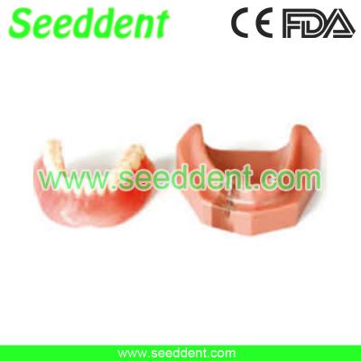 China Overdenture inferior with 2 implants for sale