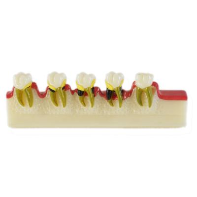 China Dental Caries Developing model / Dental Medical Teeth Teaching Model en venta