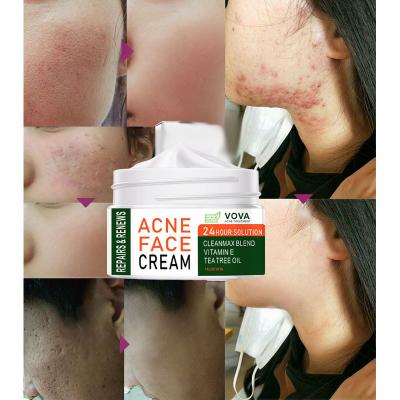 China Wholesale Anti Acne Face Oil Tree Herbal Tea Nourishing Acne Scar Removal Back Cream for sale