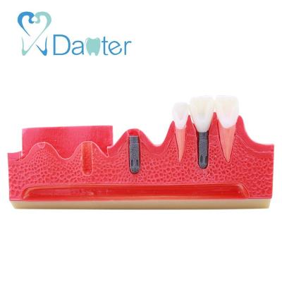 China Hospital Clinic University Factory Price Stage For Dental Implant Model For Student Practice for sale