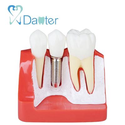 China 2018 Hospital Clinic University Hot Sale Implant Analysis Model Resin Removable Dental Implant Teeth for sale