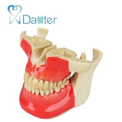 China Ortho Dental Implant Model Hospital Clinic University Good Quality Implant Practice Jaw Model for sale