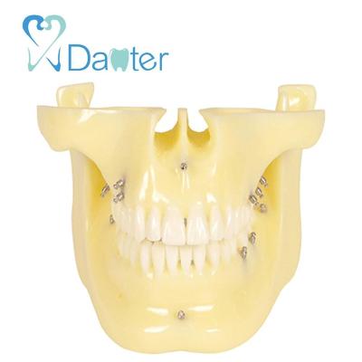 China Hospital Clinic University China Dental Orthodontic Dental Implants Model With Ortho Implant for sale