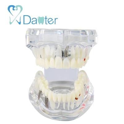 China Dental Dismountable Demonstration Study Hospital University Clinic Teaching Disease Teeth Model For Dentists And Schools for sale