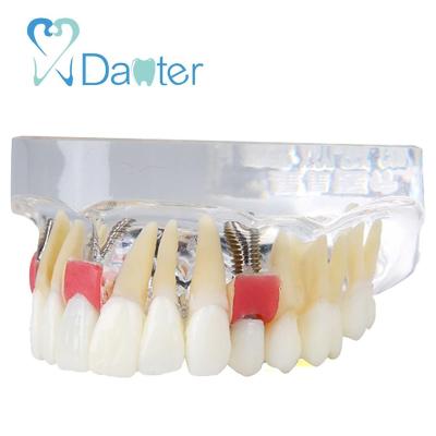 China 2018 Hospital Clinic University Top Selling Dental Implant Model With Soft Gums And Bridge for sale