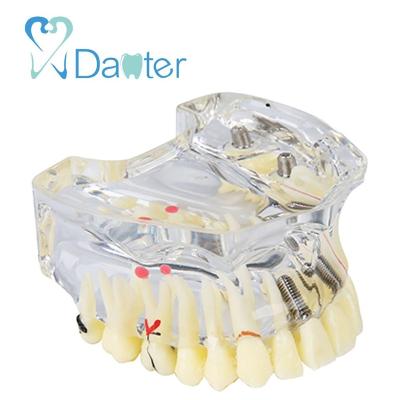 China Dental Hospital Clinic University Great Price Dental Model With Restoration And Implant for sale