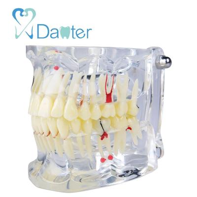 China Newest Standard Adult Pathologies Hospital Clinic University Dental Teeth Model Model With Missing Tooth for sale