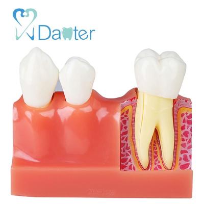 China New Type 4 Fold Endodontics Anatomy Model Hospital Clinic University Dental Model For Dentist for sale