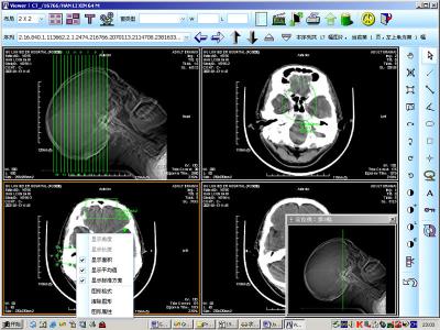 China 8 x 10inch Medical Paper Laser X Ray Diagnostic Imaging For KND-DRYTEC 4000 for sale