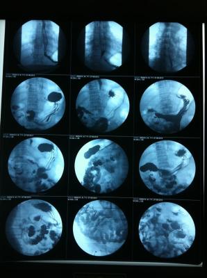 China Lichtdurchlässiger Siebdruck des Tintenstrahl-X Ray Film Glossy Surface Silk zu verkaufen