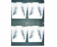 China Filme médico baixo branco do papel de X Ray Moistureproof para a impressora a laser de Sony/EPSON à venda