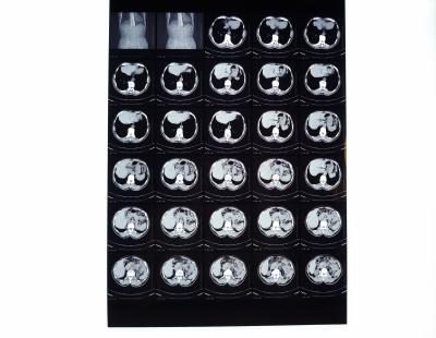 China Medische Röntgenstraalfilms, Droge Weergavefilm Compatibel met Thermische Printer voor CT/DR./MRI Te koop