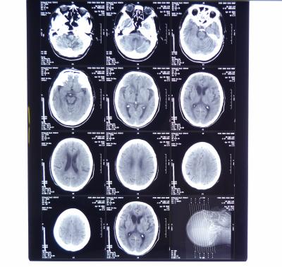 China 11in * 14in X-ray Dry Medical Imaging Films KND-A For  AGFA 5300, 5302, 5500, 5502, 3000 for sale