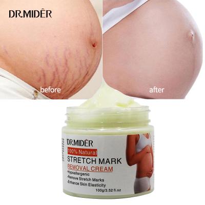 China High Quality Powerful Moisturizer Stretch Marks Remover Skin Repair Cream Treatment Marks Removal Pregnancy Cream for sale