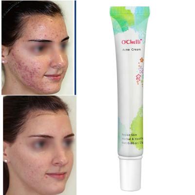 China Acne Treatment ONE DAY CAN SEE TO RESULT Oil Control Acne Treatment Elica Cream For Acne for sale