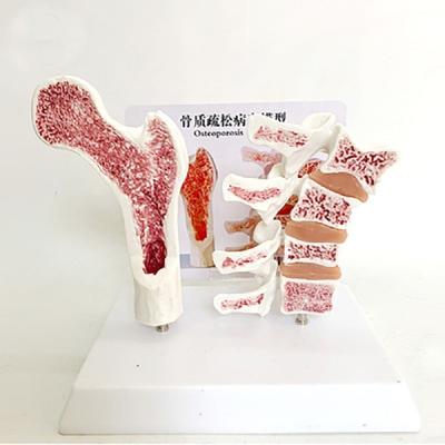 China Teaching Human Anatomical Model Skeleton Osteoporosis Simulation Model for sale