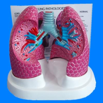 China Pathological teaching medical bronchopulmonary disease and lung anatomical model for sale