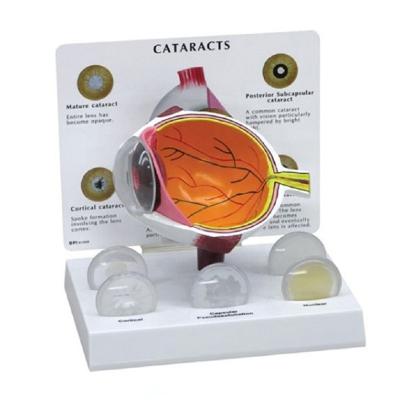 China Teaching Eye Model Cataract Eyeball Pathological Anatomical Model for sale