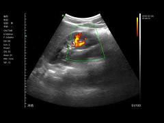 BIO - W4 Wireless Color Doppler Probe Scans Kidney PDI Mode