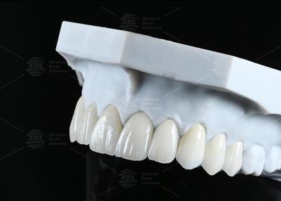 China Translucidez CAD EMAX Veneer Pulida Restauración de cerámica acristalada para áreas anteriores y posteriores en venta