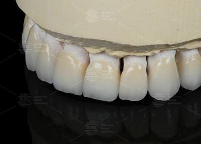 China Color natural de los dientes Cerámica de carilla feldspática para dientes anteriores y posteriores en venta