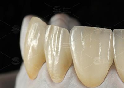 China 0.3mm-0.7mm Carillas de cerámica EMAX Feldspathic Carillas dentales Emax estéticas naturales en venta