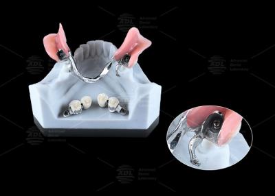 China 0.1mm Tolerance CEKA REVAX Attachment Titanium 3mm Vertical Clearance for sale