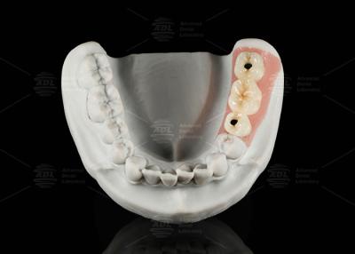 China Screw Retained Titanium Custom Abutment Porcelain Fused To Zirconia for sale