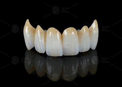 China High Translucency Full Contour Zirconia Bridge Chipping Resistance Natural Esthetics for sale