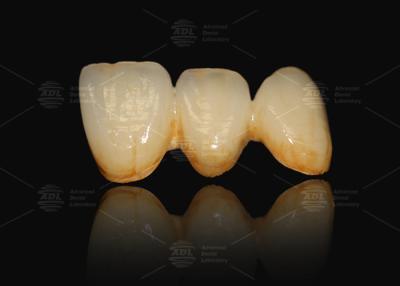 Cina A3 A3.5 Porcellana fusa al metallo e corona dentale in ceramica PFM Cad Cam in vendita