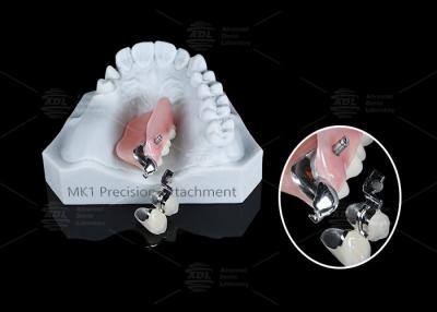 China MK1 Precision Attachment Removable Partial Denture Easy Installation for sale