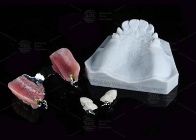 Cina Protesi dentali Via chiave Attachment Precisione Attachment Forza di ritenzione regolabile in vendita