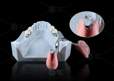 China Sleek Precision ERA Dental Attachments For Universal Secure Dental Prosthetics for sale