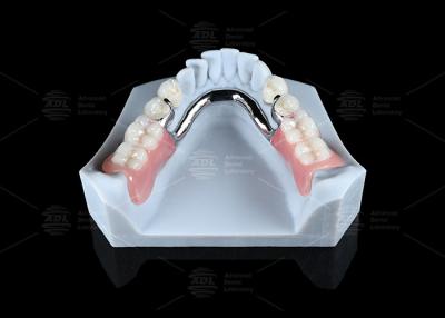 China Adjustable Multi Functional ERA Precision Attachment Removable ERA Attachments For Dentures for sale