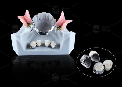 China CE FDA Ball Attachment Dentures Comfortable Denture Ball Attachment Long Lasting for sale